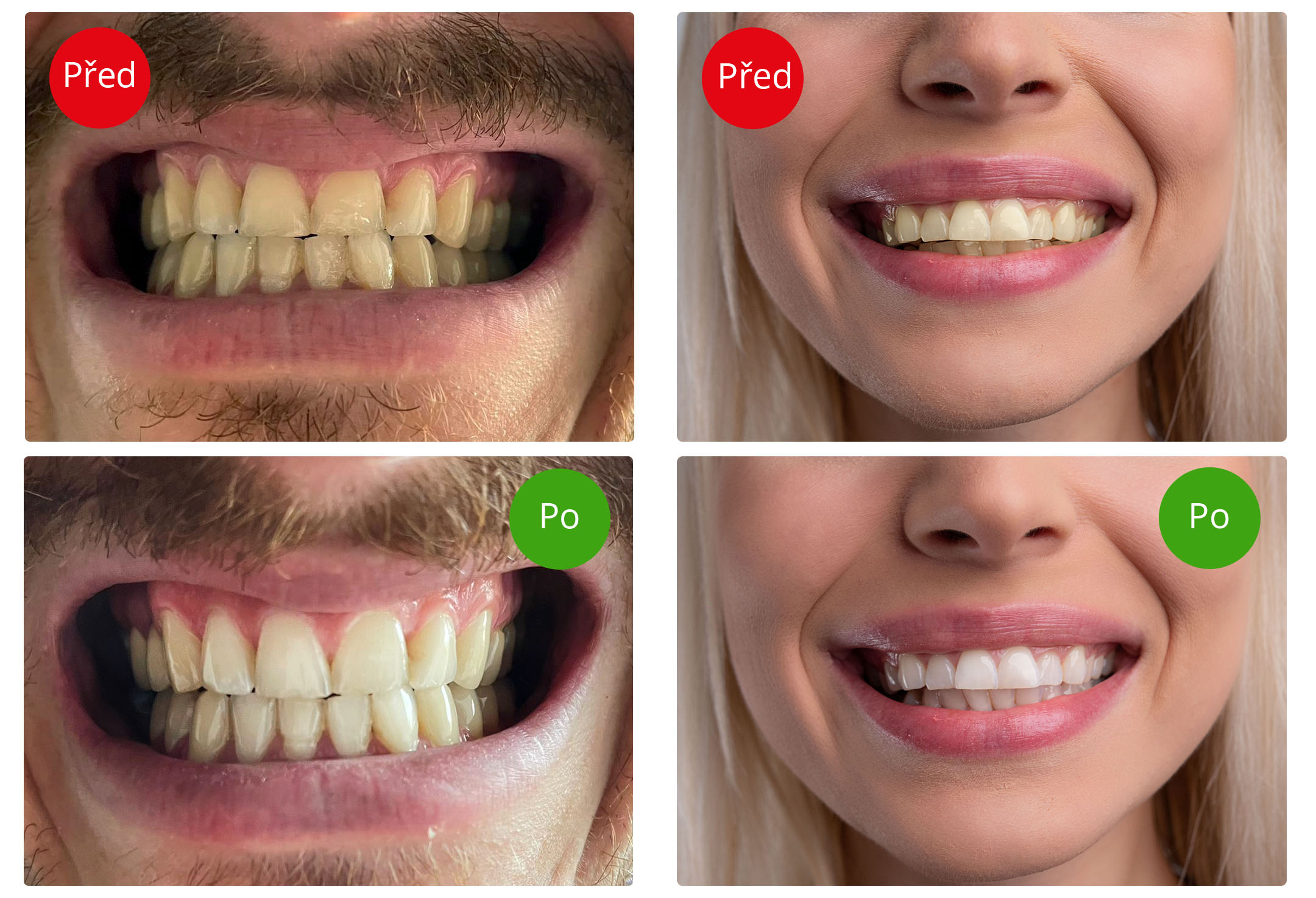 Blight Smile Black, Světelná sada pro bělení zubů Obrázek