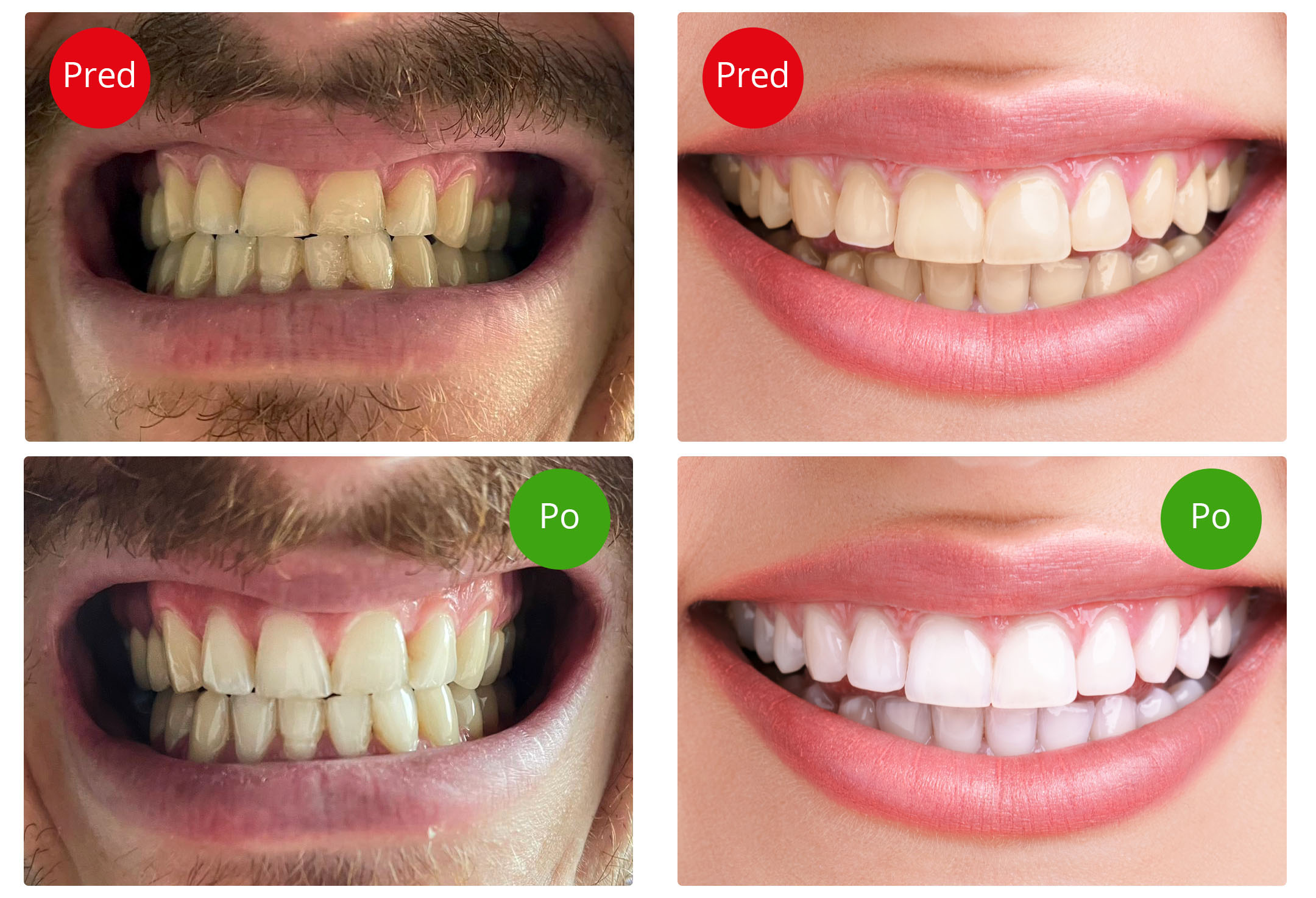 Blight Smile, Světelná sada pro bělení zubů Obrázek