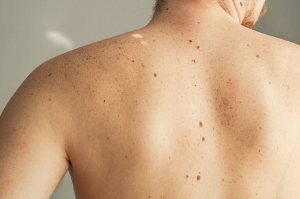 Jak vypadá rakovina kůže?