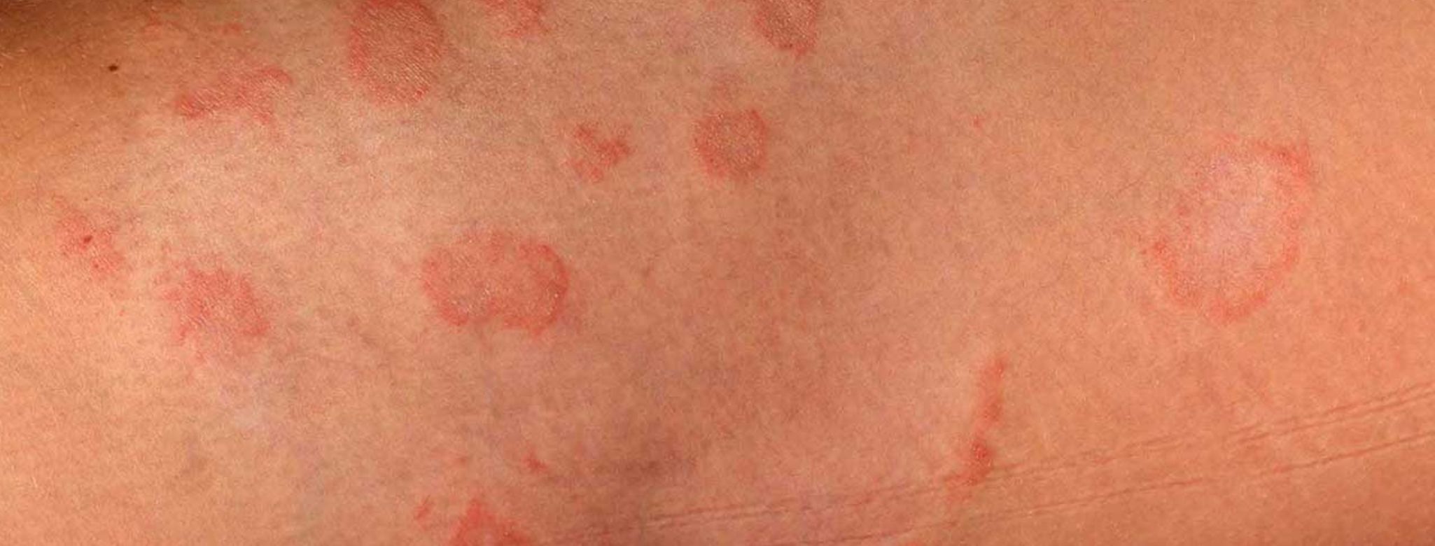 Kvasinková infekce kůže, Candida Albicans - Jak ji poznat a jak ji vyléčit?